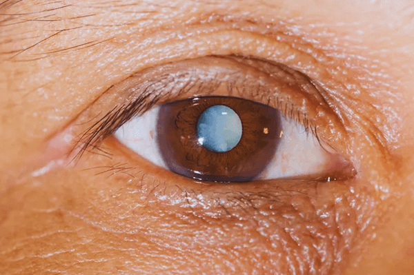 Cataract Detection Using Machine Learning